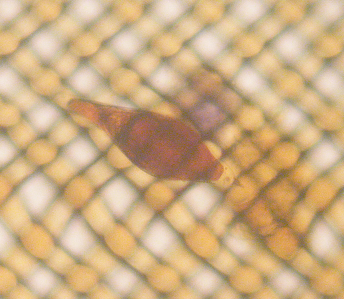 An atypical egg of a schistosome hybrid in Malawi 