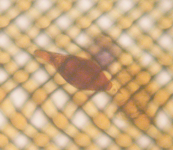 An atypical egg of a schistosome hybrid in Malawi An atypical egg of a schistosome hybrid in Malawi