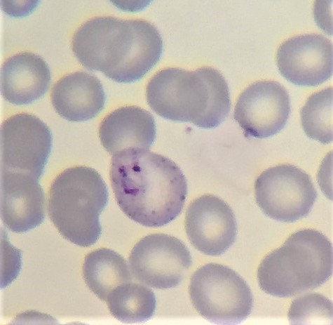 Malaria parasite has infected one of these red blood cells. Blood cells are subjectively the most important cells of the body. Malaria parasite has infected one of these red blood cells. Blood cells are subjectively the most important cells of the body.