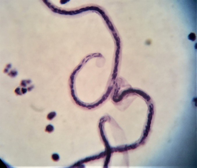 Microfilarial worms in the blood. The surrounding white blood cells watch on with some trepidation.