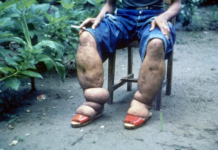 Severe swelling (oedema) of the legs due to lymphatic filariasis. Image source CDC. Severe swelling (oedema) of the legs due to lymphatic filariasis. Image source CDC.