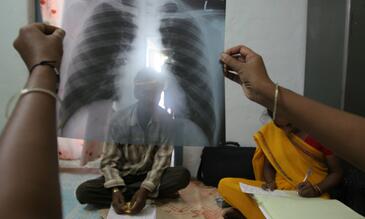 © Flickr Creative commons - Gates Foundation World TB Day