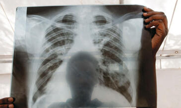 A chest X-ray from a patient with tuberculosis (TB) in Lira, Uganda. Credit: J. Matthews/Panos