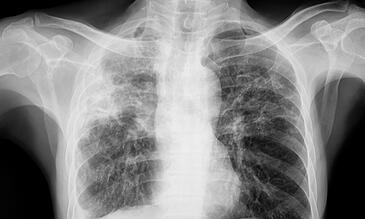 Lungs affected by TB