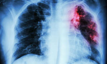 X  ray image of scarring on the lung