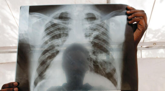 A chest X-ray from a patient with tuberculosis (TB) in Lira, Uganda. Credit: J. Matthews/Panos