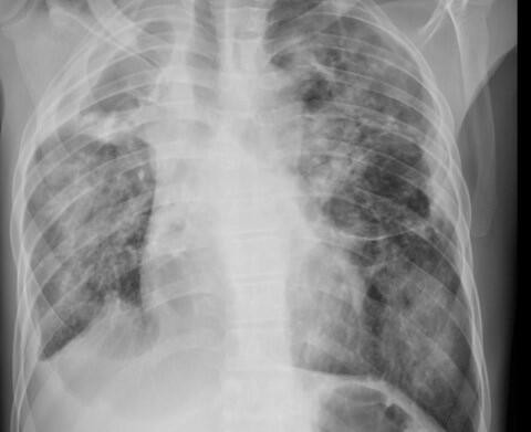 X-Ray showing the chest of a patient reporting breathlessness