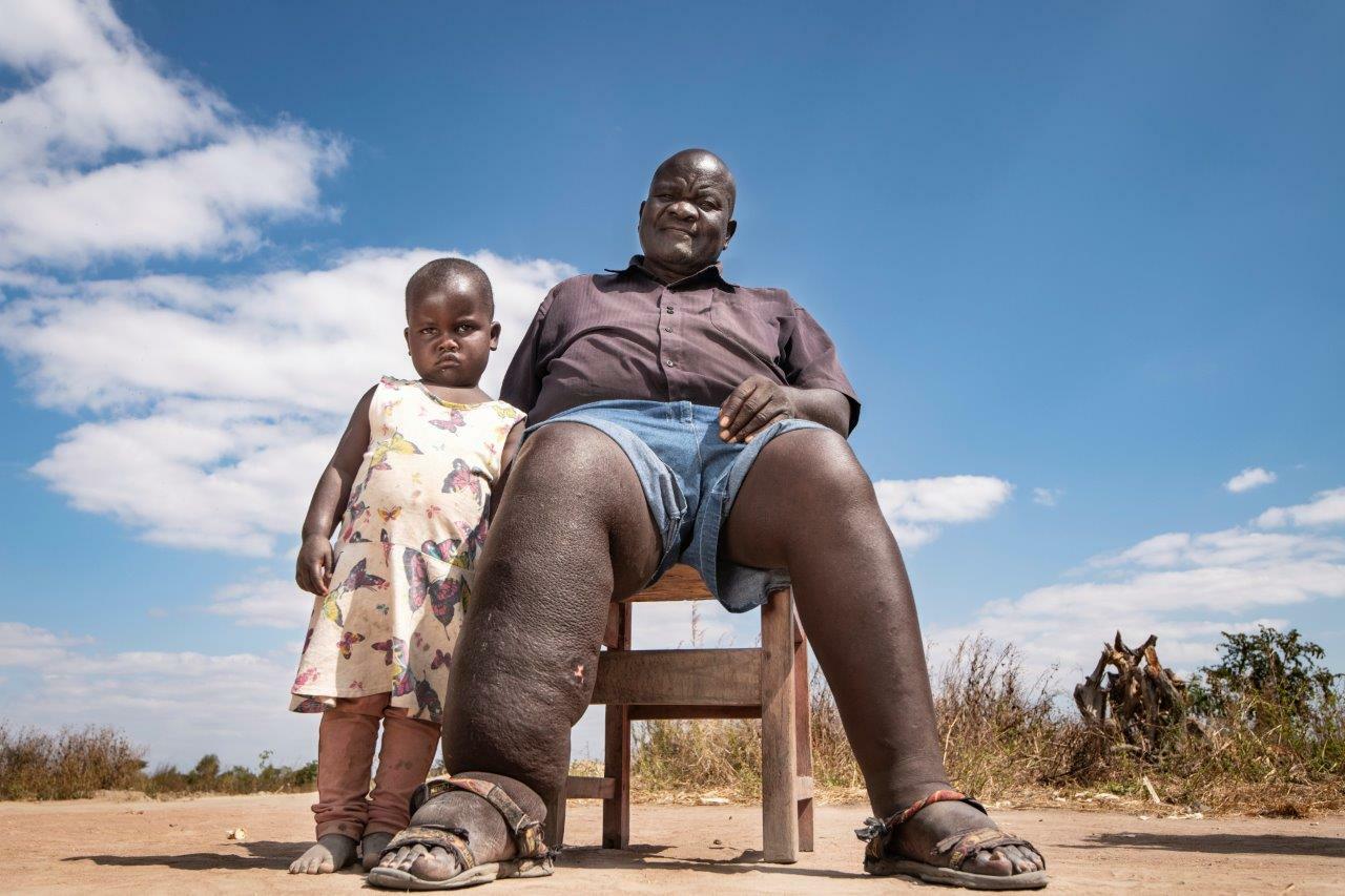 Laitchani Levson developed LF in 2001. His granddaughter Elfrieda is pictured next to his swollen leg - Photo credit: Simon Townsley/Daily Telegraph