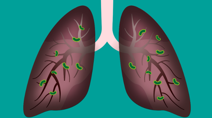 The animation is a collaboration between LSTM, several teams at the Liverpool University Hospitals NHS Foundation Trust (LUHFT), Cheshire and Merseyside Cancer Alliance and City Health Care Partnership Animation of a pair of lungs