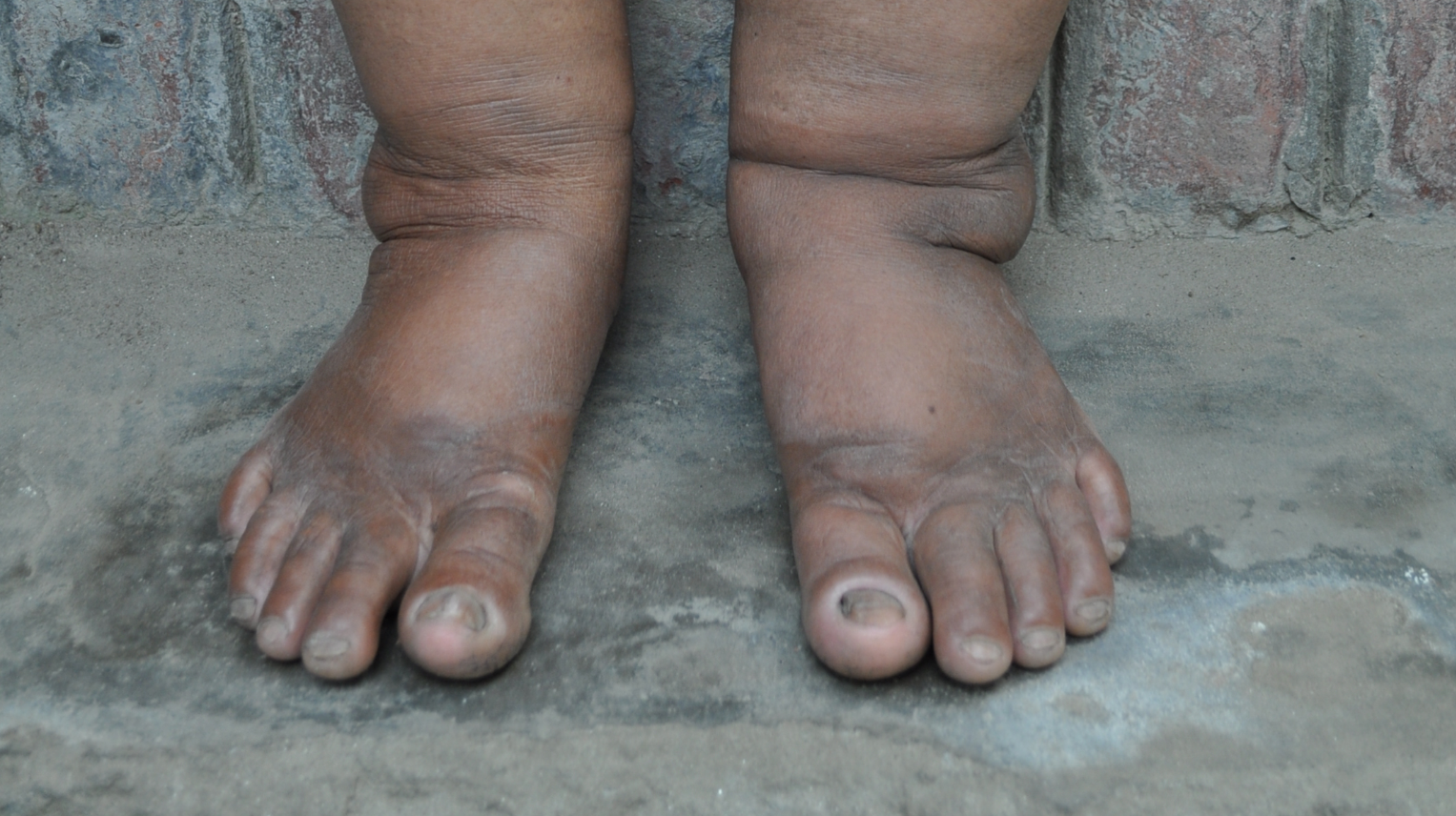 A patient in Bangladesh with Lymphodema - a symptom of LF