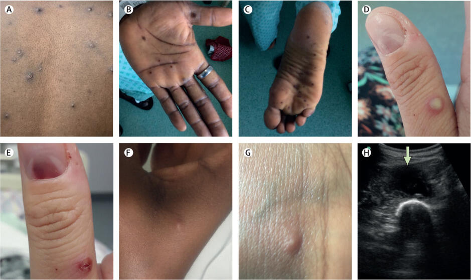 Skin and soft tissue manifestations of monkeypox. Credit: Lancet Infectious Diseases