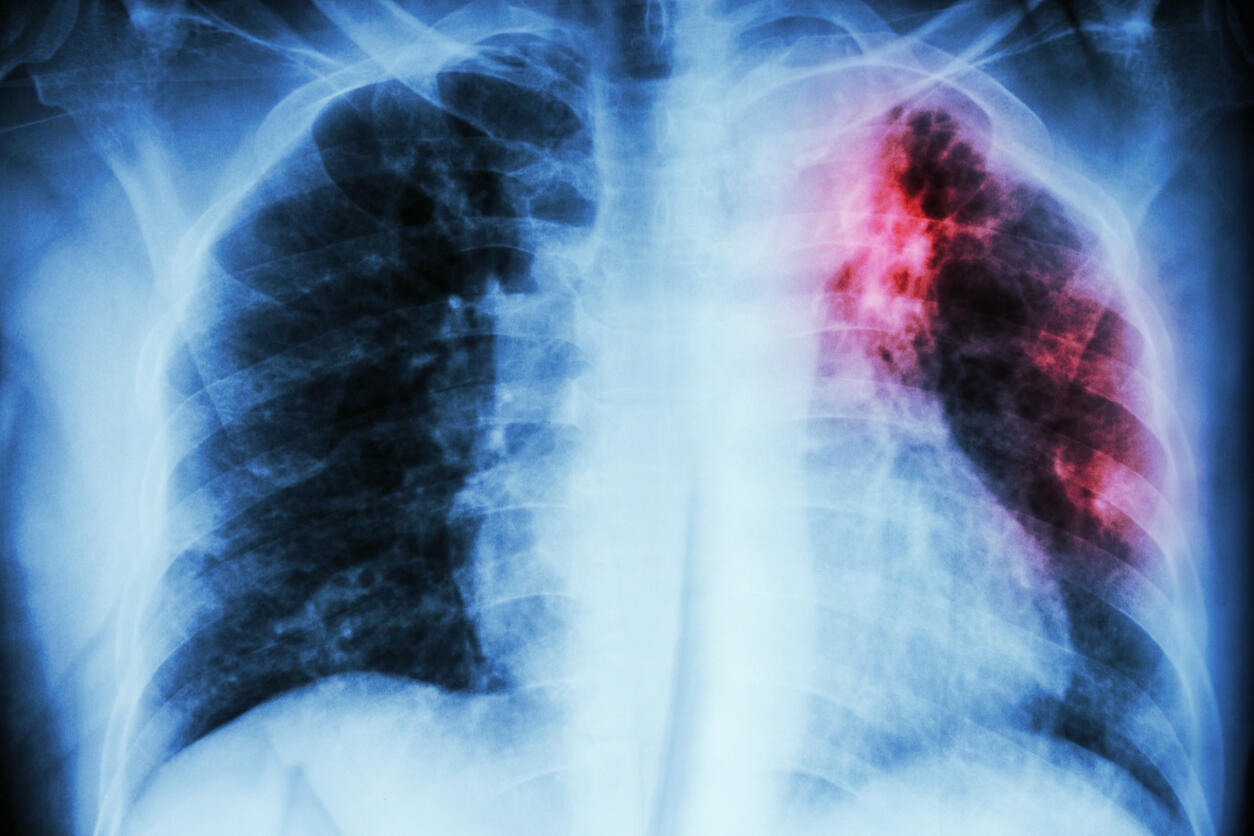 X  ray image of scarring on the lung