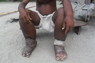 Insecticide-treated bed nets critical to global elimination of elephantiasis | LSTM