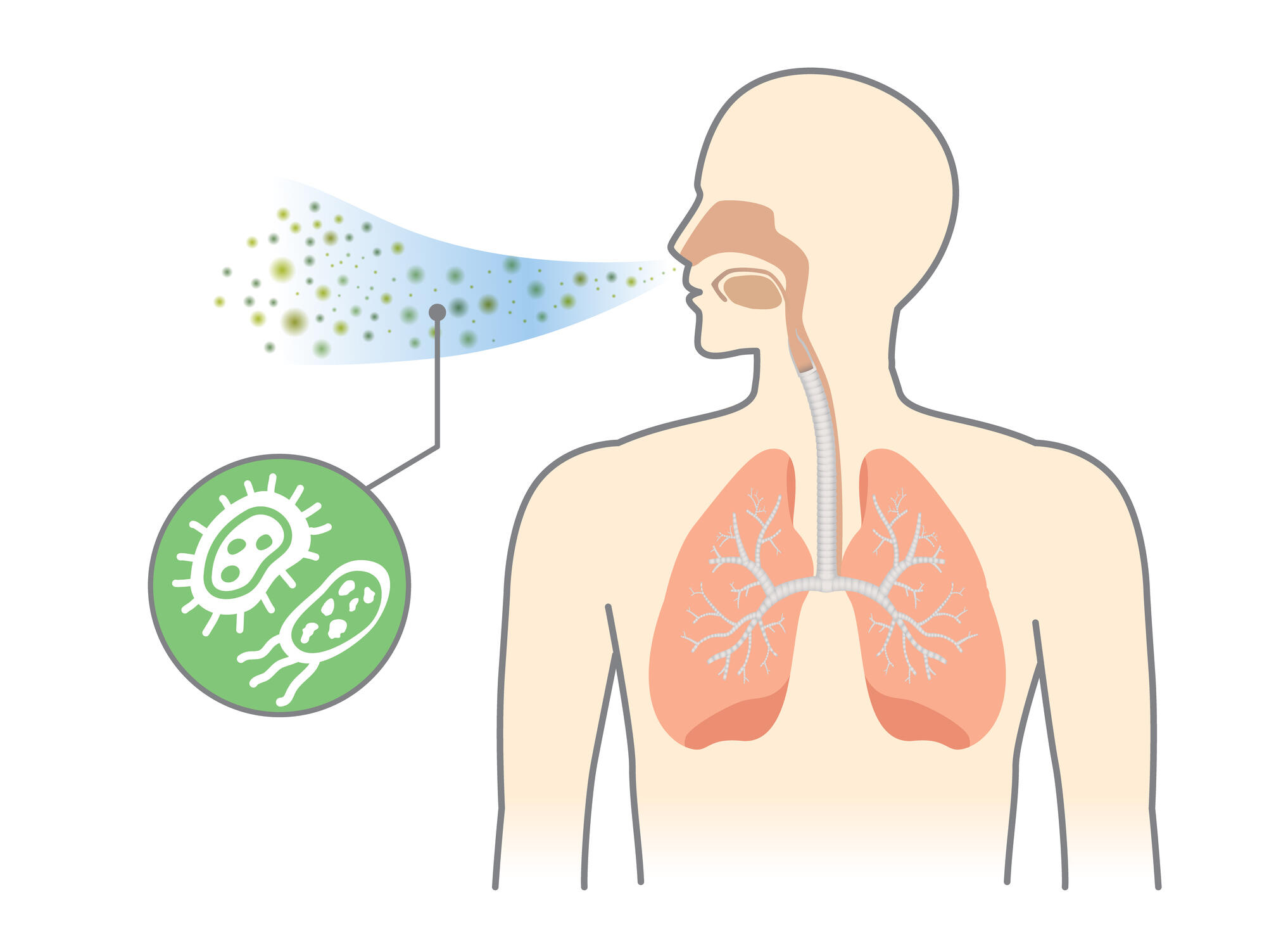 What is pneumonia? LSTM