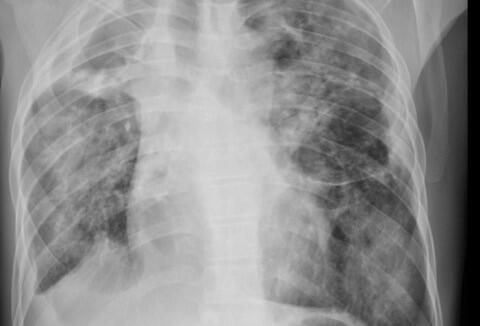 X-Ray showing the chest of a patient reporting breathlessness