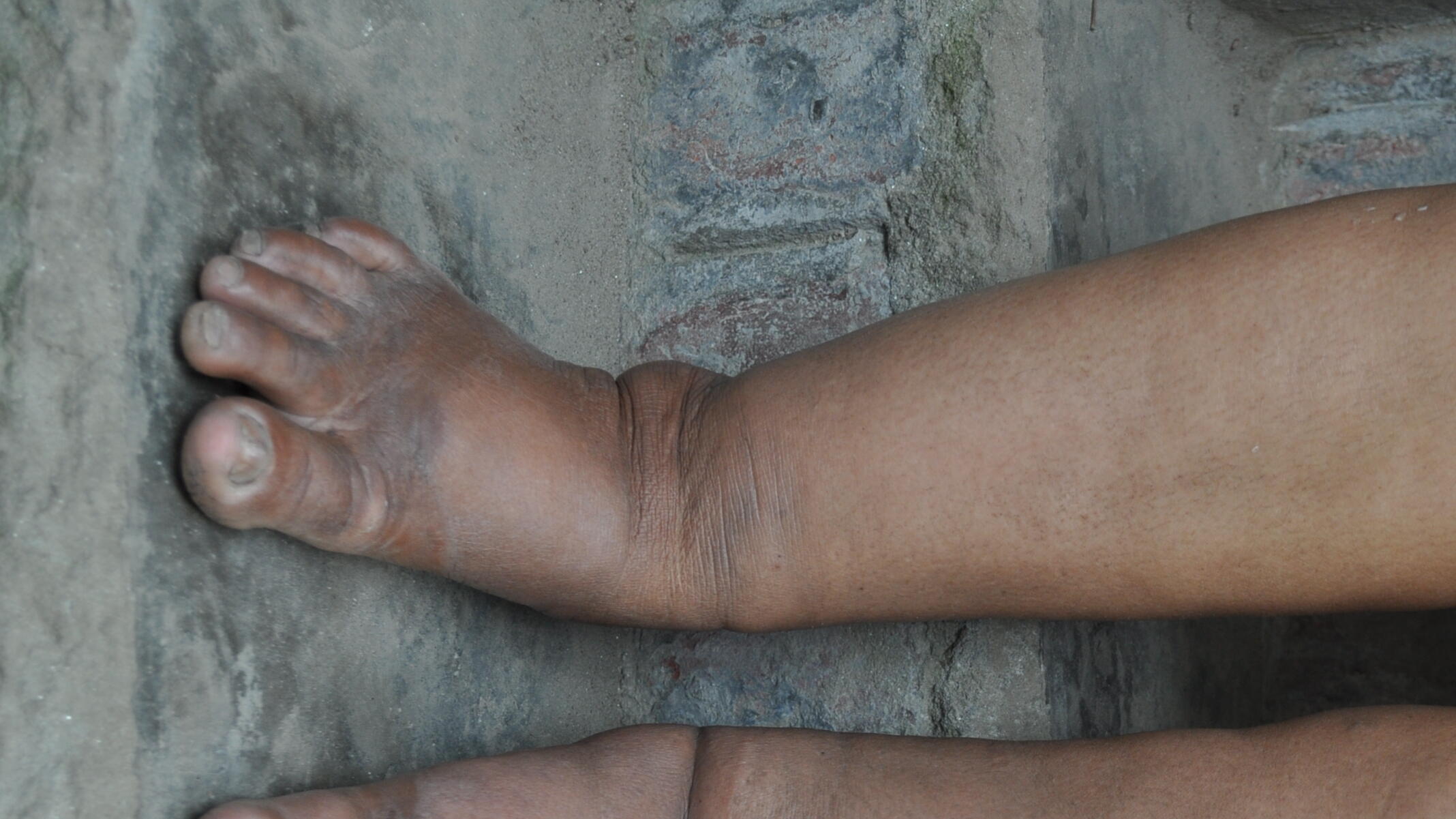 A patient in Bangladesh with Lymphodema - a symptom of LF