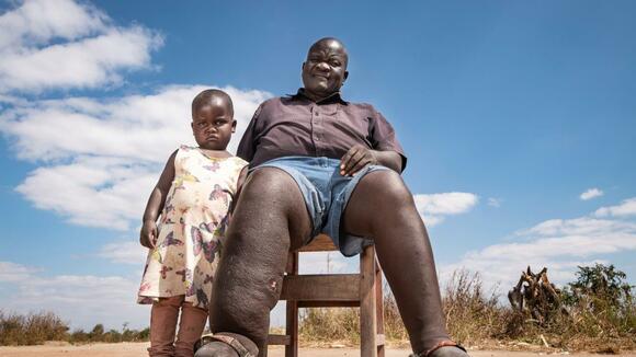 Laitchani Levson developed LF in 2001. His granddaughter Elfrieda is pictured next to his swollen leg - Photo credit: Simon Townsley/Daily Telegraph