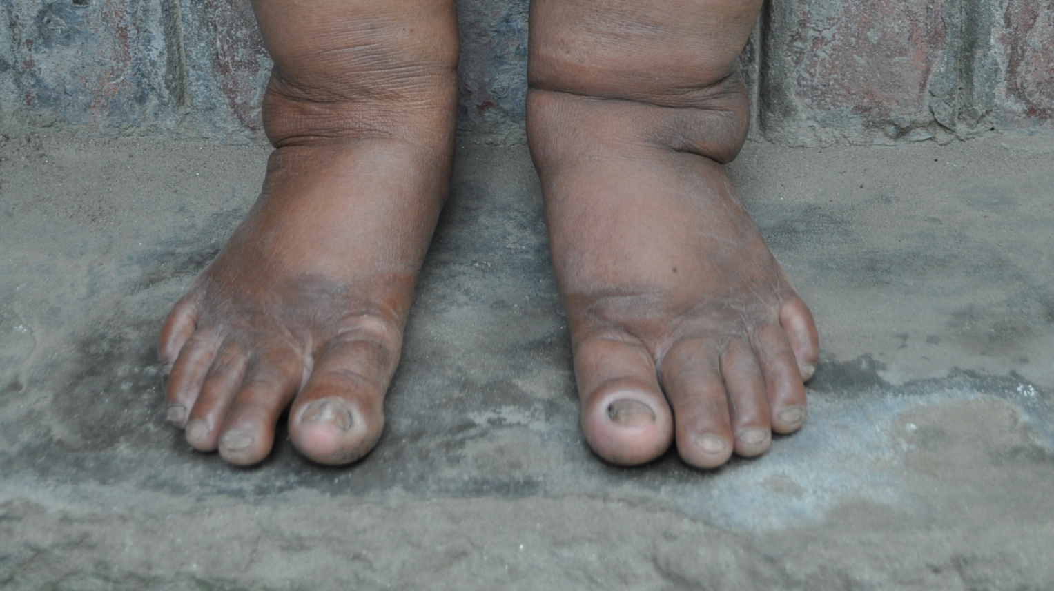 A patient in Bangladesh with Lymphodema - a symptom of LF