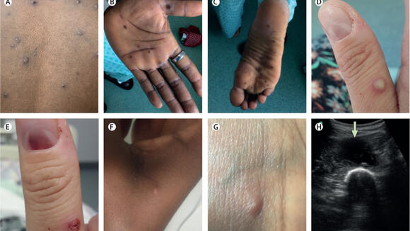Skin and soft tissue manifestations of monkeypox. Credit: Lancet Infectious Diseases