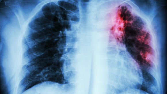 RESPOST will examine the potential UK prevalence of post-TB lung disease (image: iStock) X  ray image of scarring on the lung